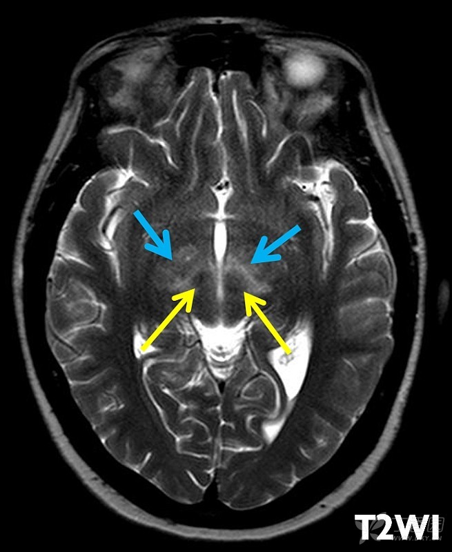 2月晨读病例之0212 中年女性,视力下降(有理有据的
