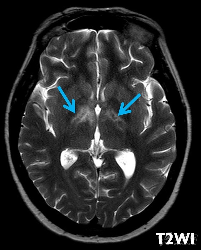 2月晨读病例之0212 中年女性,视力下降(有理有据的
