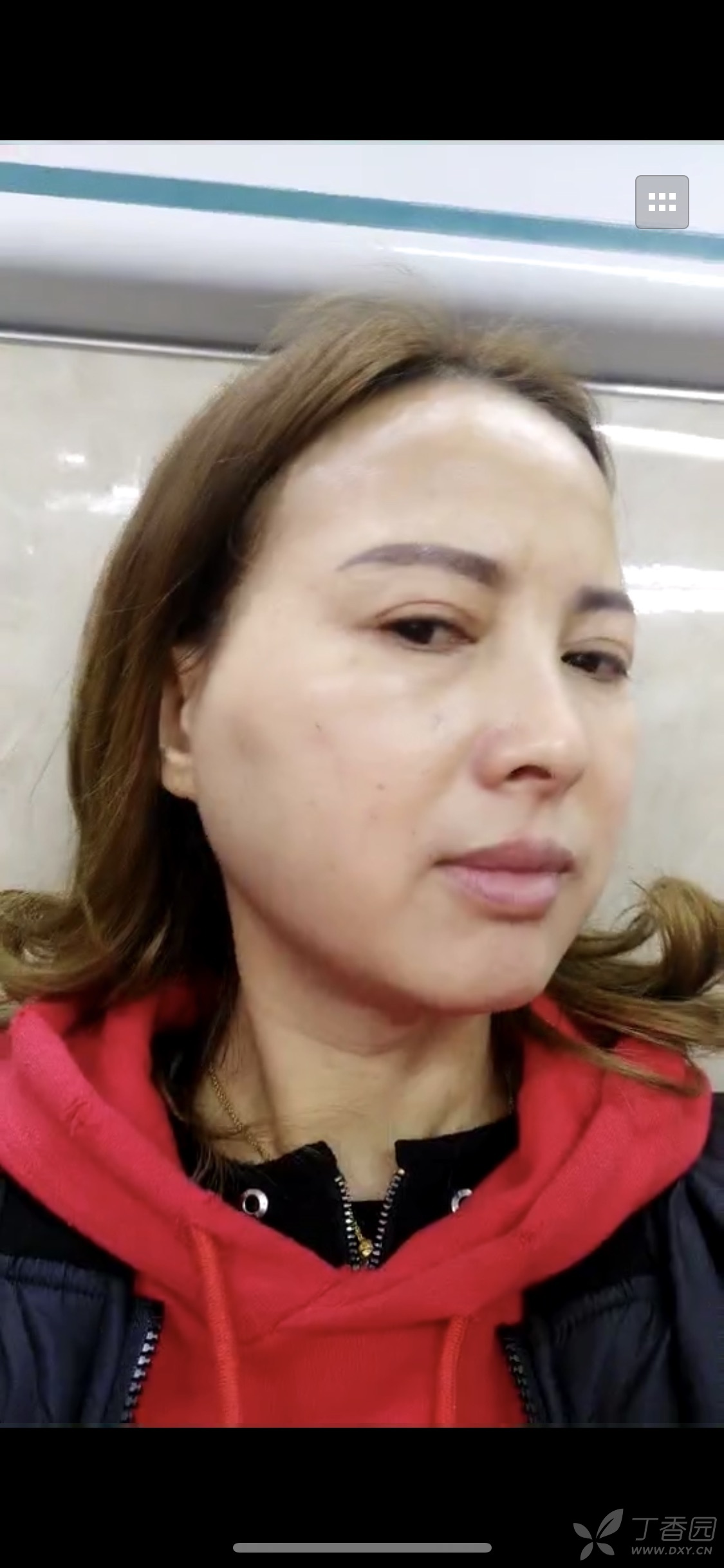 玻尿酸注射面颊后莫名肿胀特别严重!