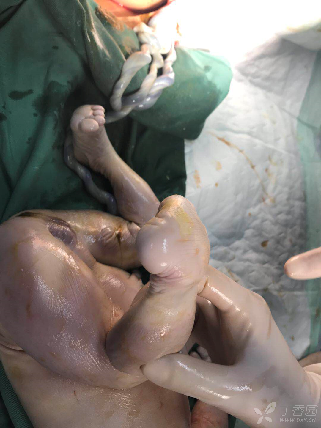 35周胎儿生下来照片图片