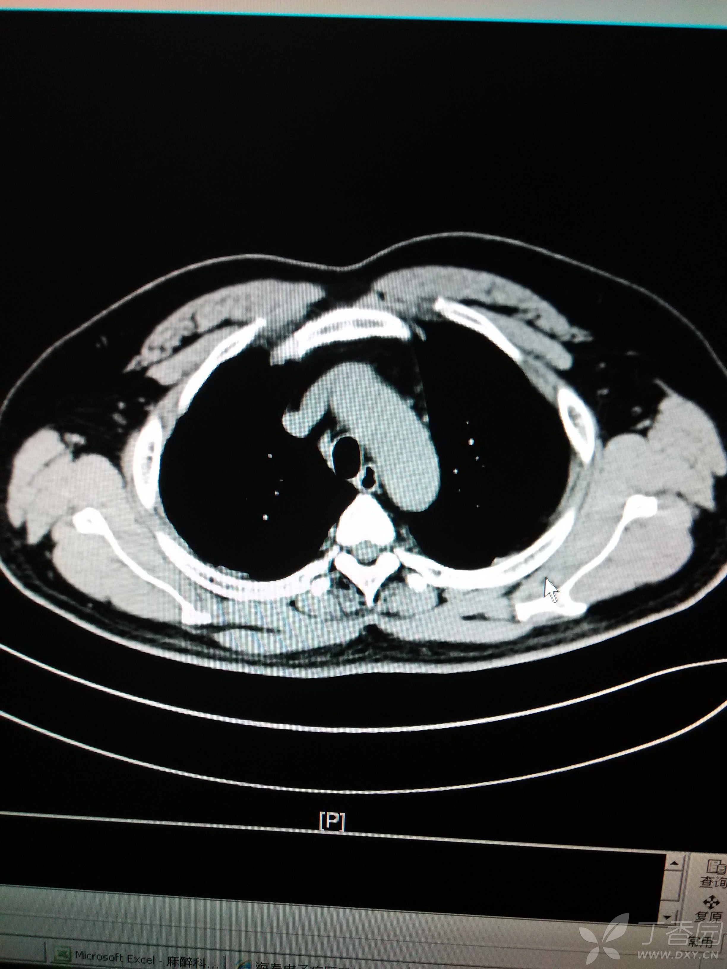 胸腔里冒出这么大个肿物!(1 楼公布病理结果) [病例帖]