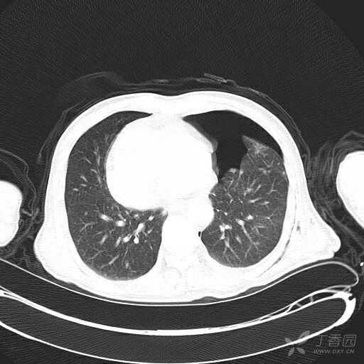 此为第二例对比气胸