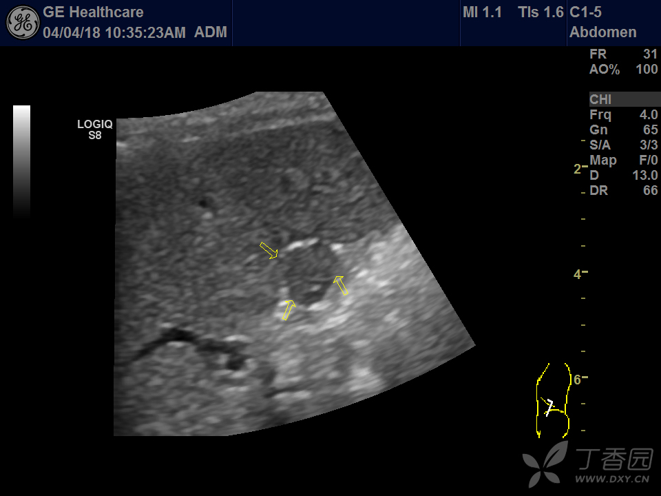 副脾? - 超声医学讨论版 -丁香园论坛