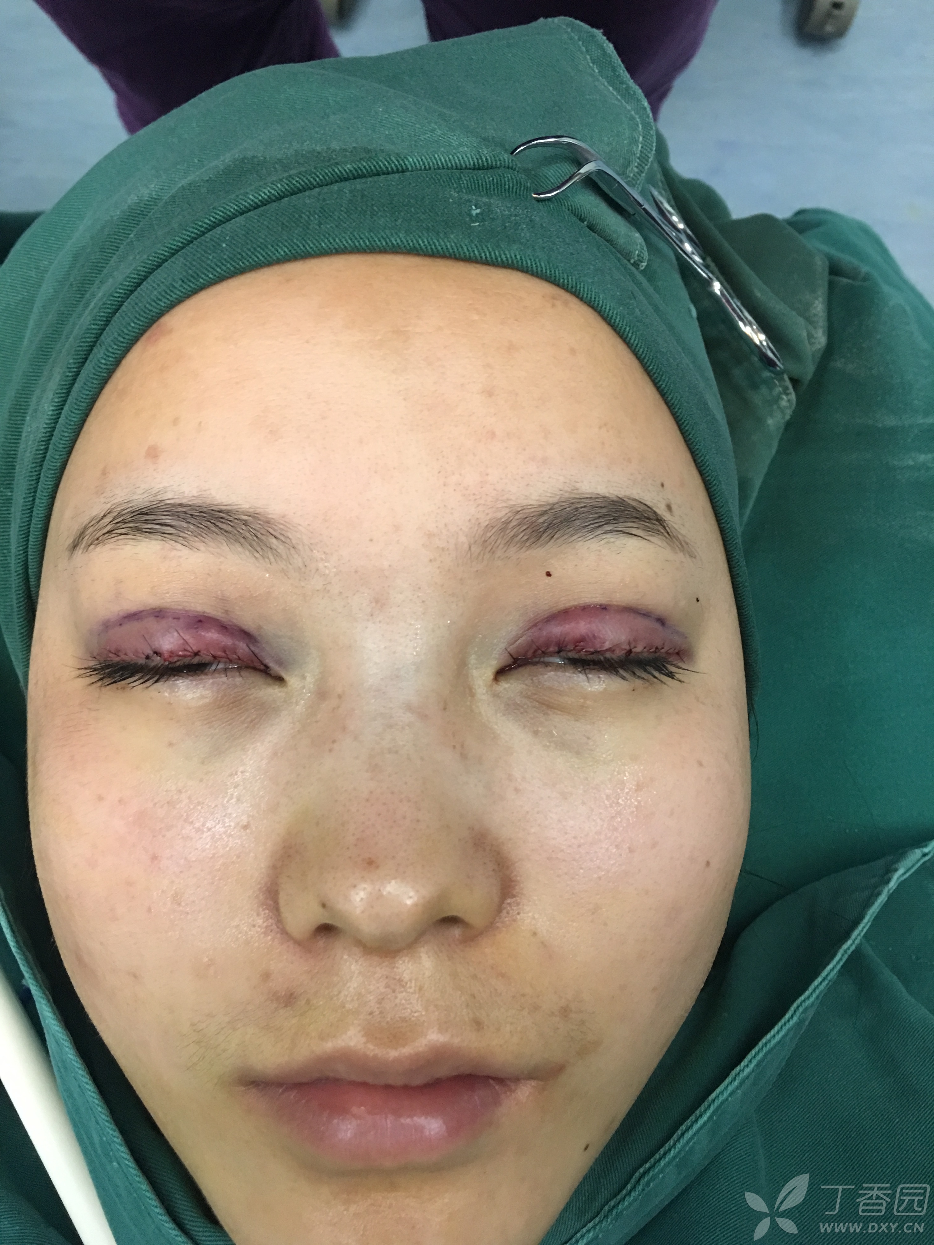 经睑缘切口重睑术