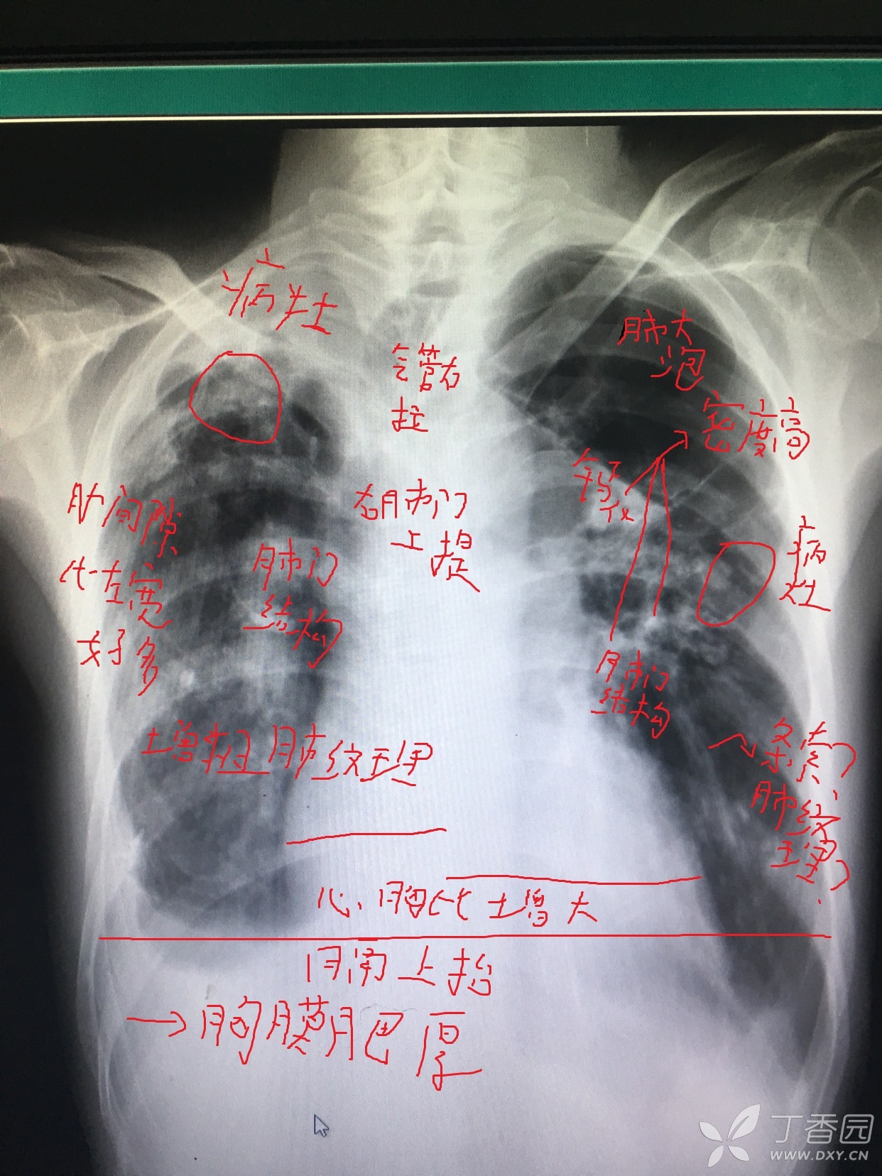 肺结核胸片阳性图片