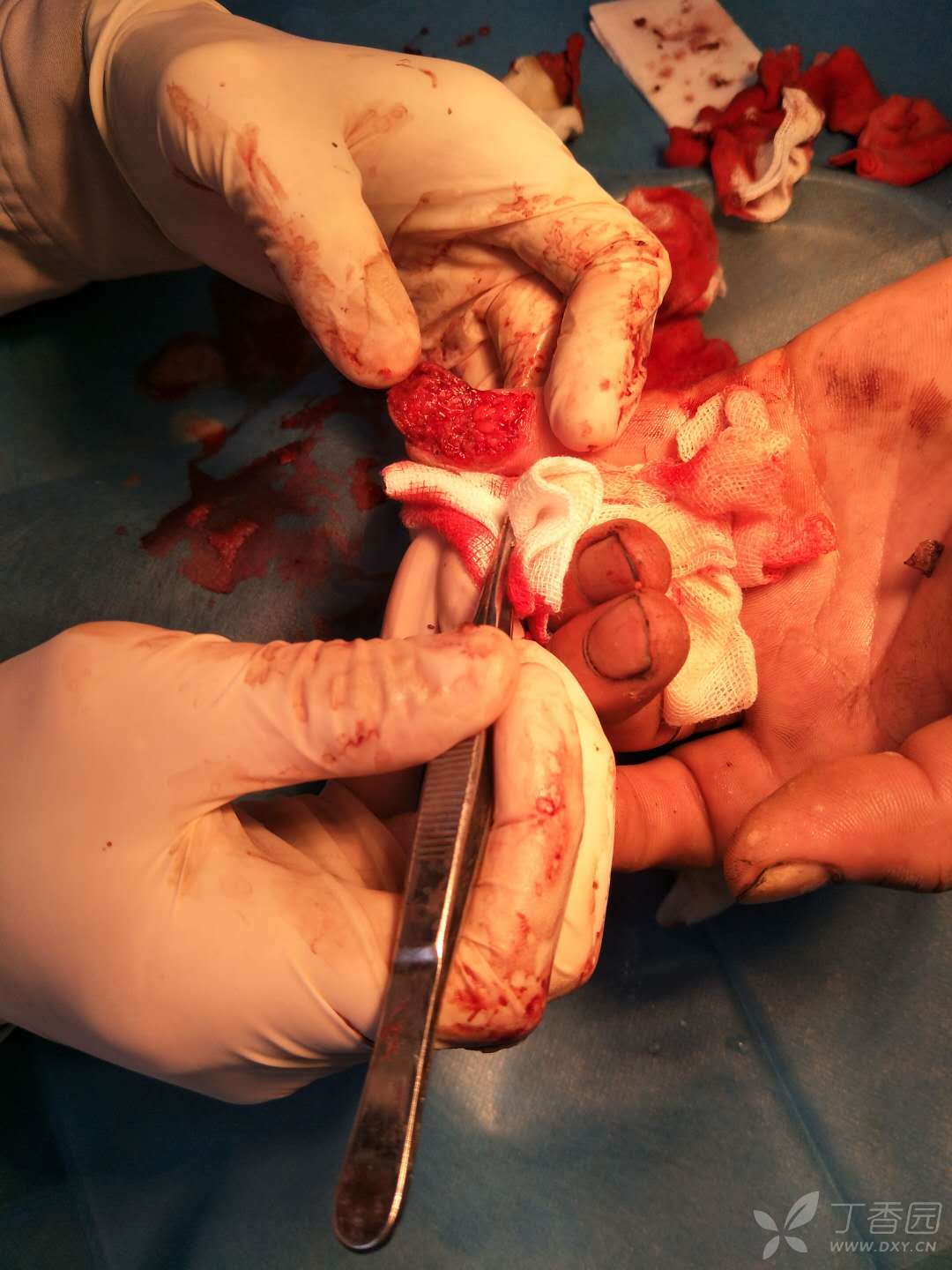 普通外科讨论版 软组织感染 相关疾病: 病人是被钝器夹伤,然后撕裂