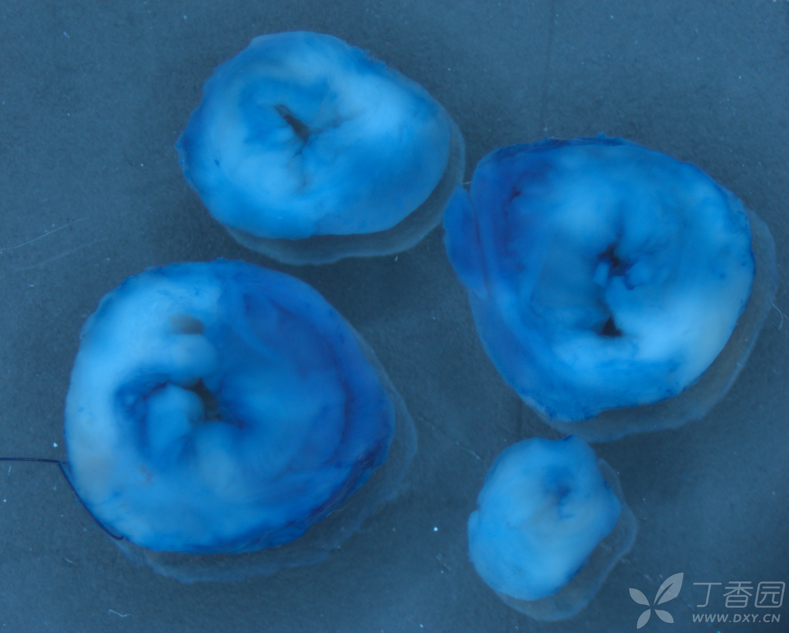 心梗后evans blue ttc染色结果请教