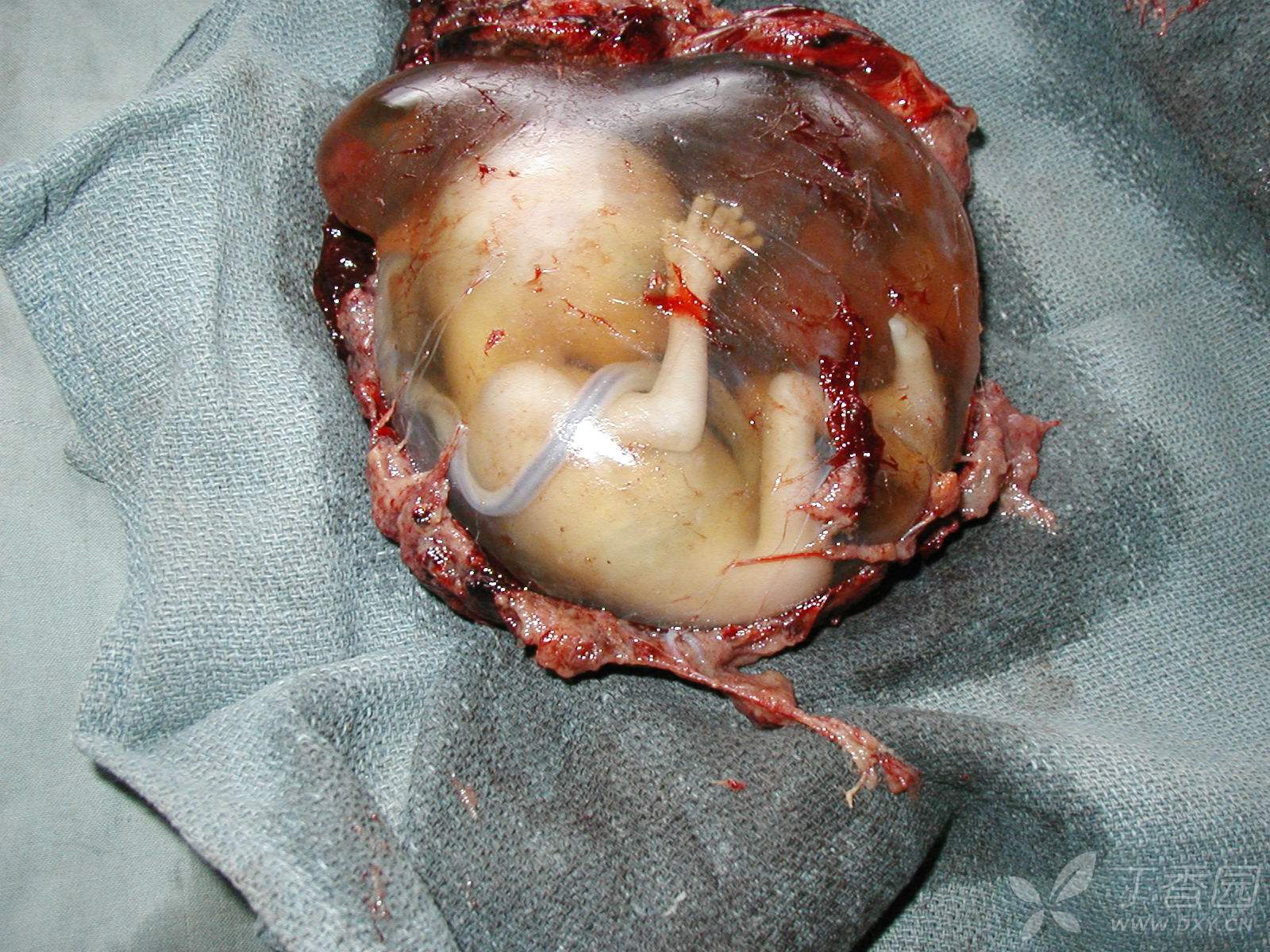 【罕见】剖腹探查发现的异位妊娠,你猜是哪个部位的?