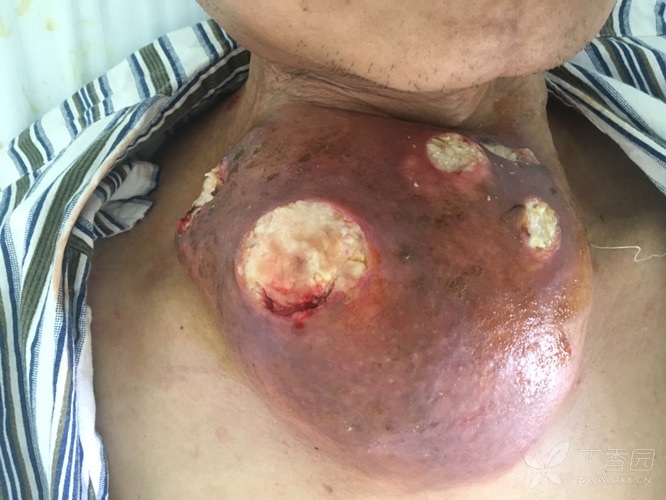 舌癌术后一年,颈前大肿块,是舌癌复发吗? [病例帖]