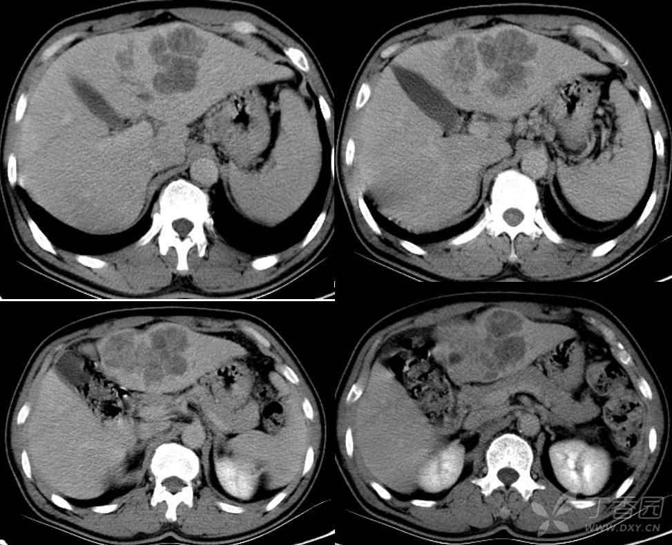 静脉期ct值约47hu-114hu