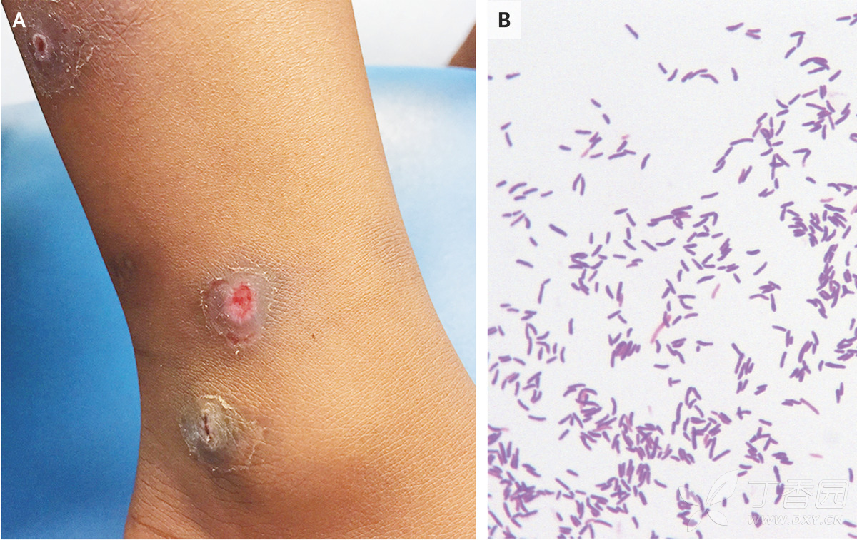 nejm病例报道:皮肤白喉