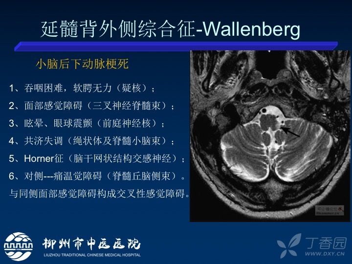 延髓背外侧综合征图片