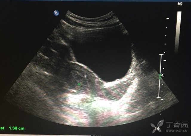 子宫内高回声团