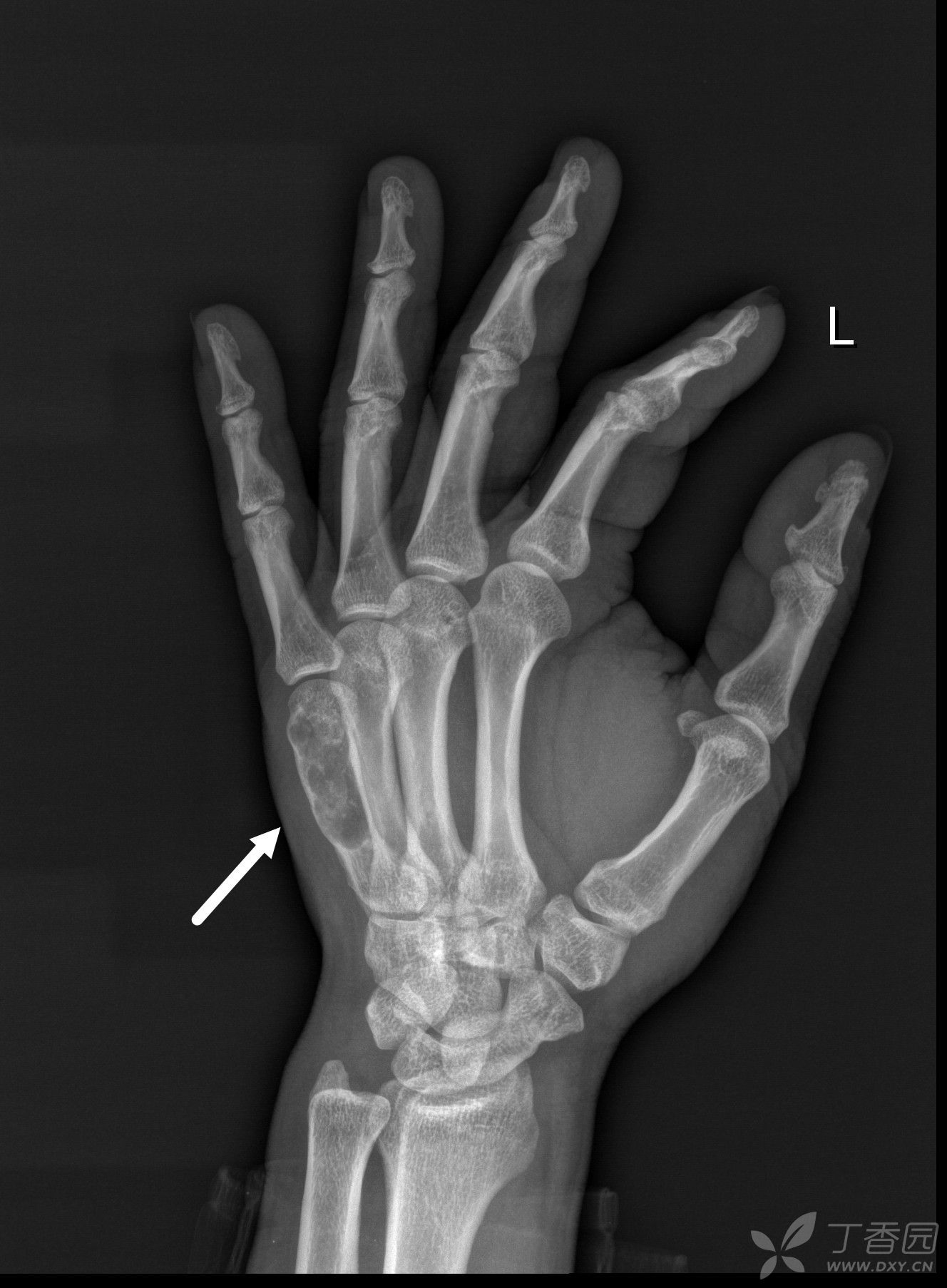 分享几例内生软骨瘤(未经病理证实),欢迎讨论,批评指正!