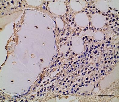 【请教】免疫组化图片解读