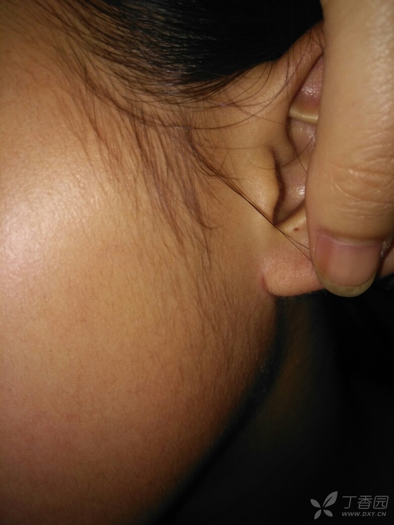小孩耳朵脆骨断裂图片图片