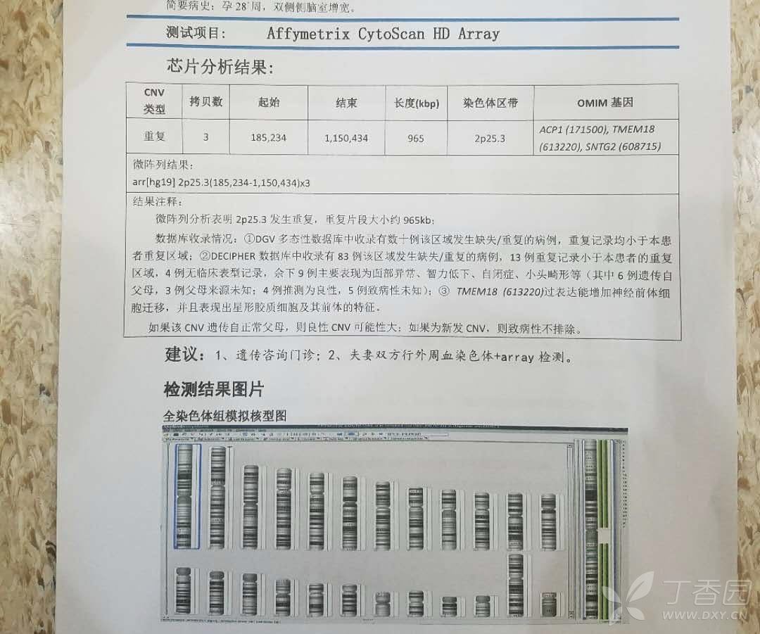 胎儿2号染色体2p25.3发生重复,重复片段大小约965kb