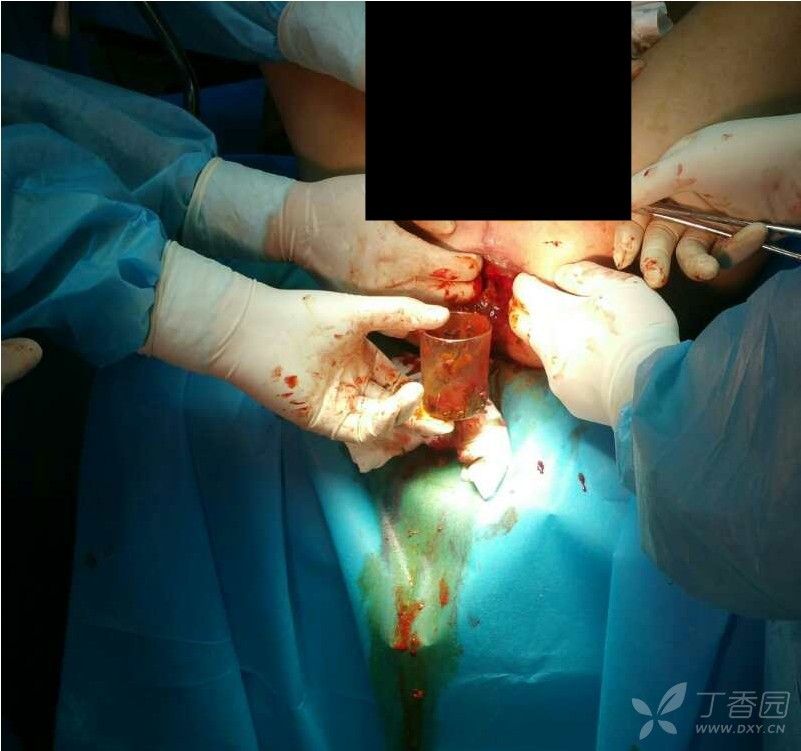 一例直肠内异物取出 [病例帖]