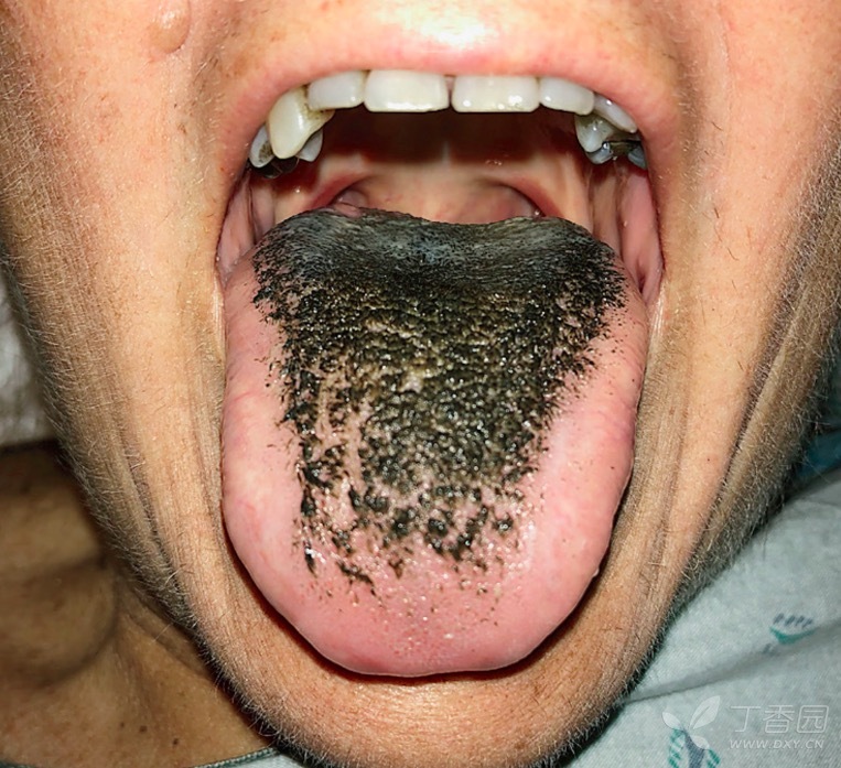舌头发黑发黄图片