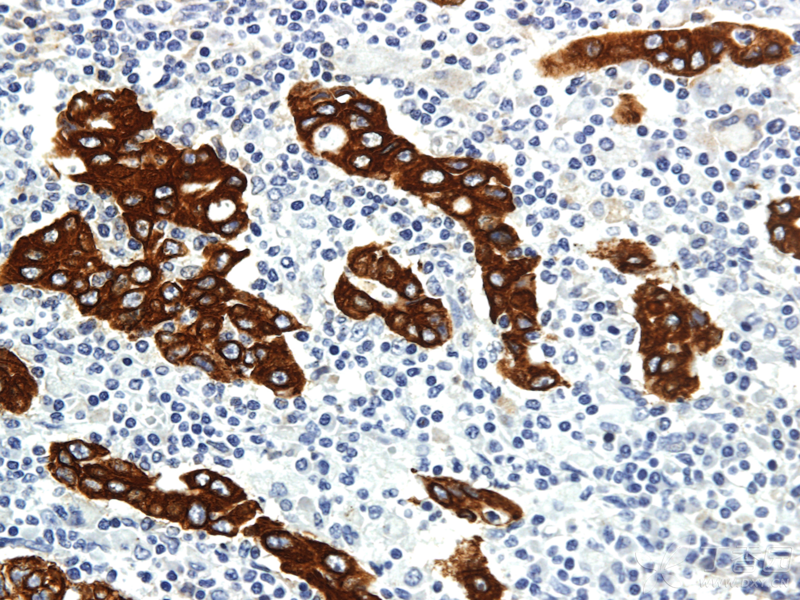 【原创】病理学之免疫组化染色篇