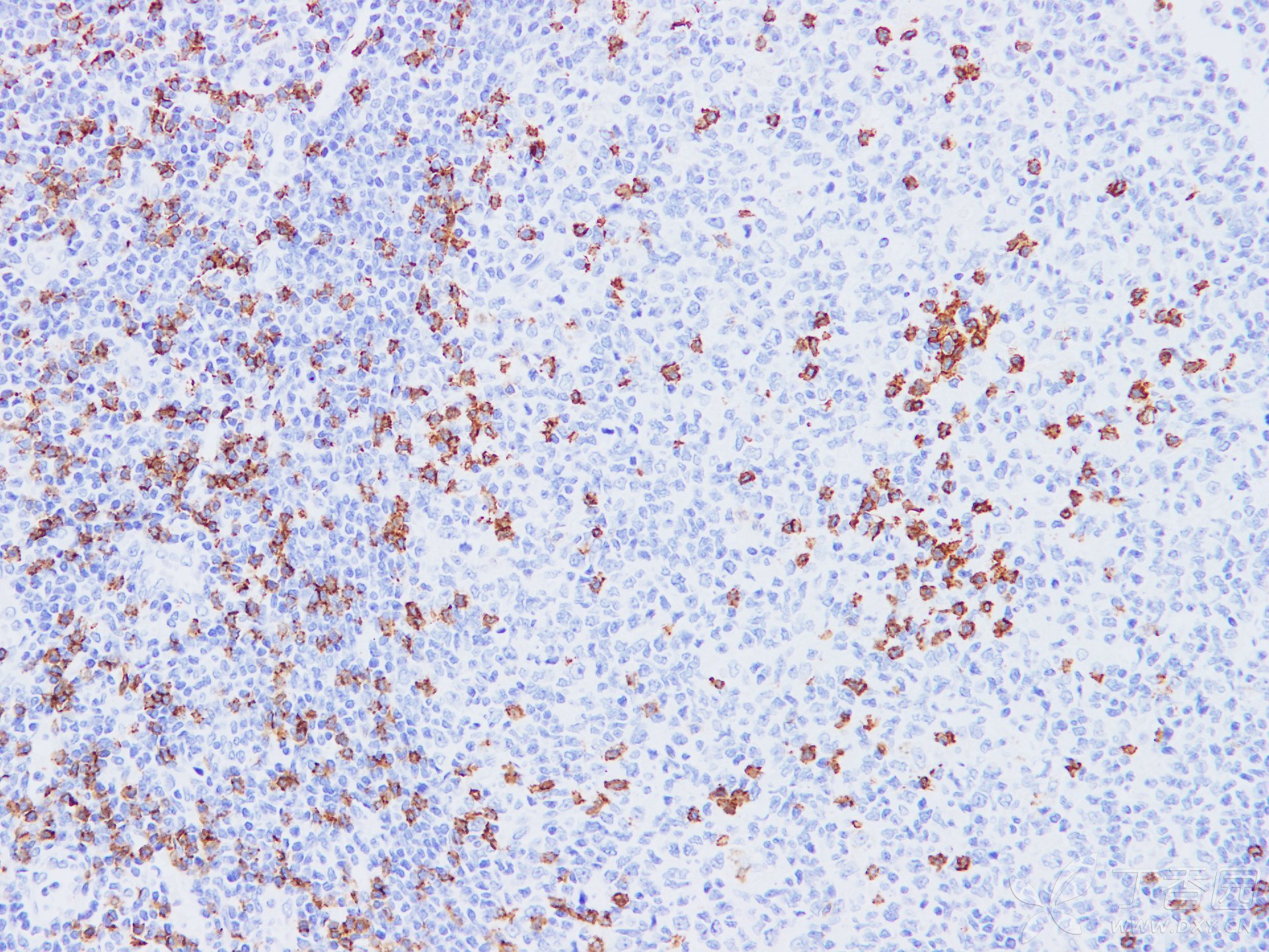 【原创】病理学之免疫组化染色篇