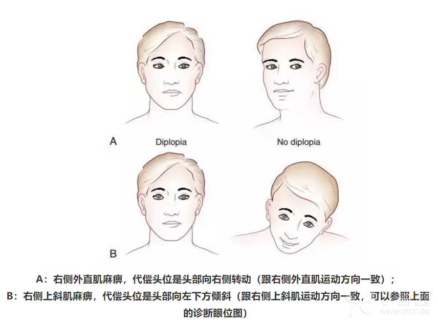 右侧颞部头痛及右眼部疼痛 上斜肌麻痹=痛性眼肌麻痹? [病例帖]