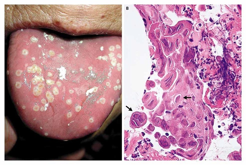 皰疹性舌炎