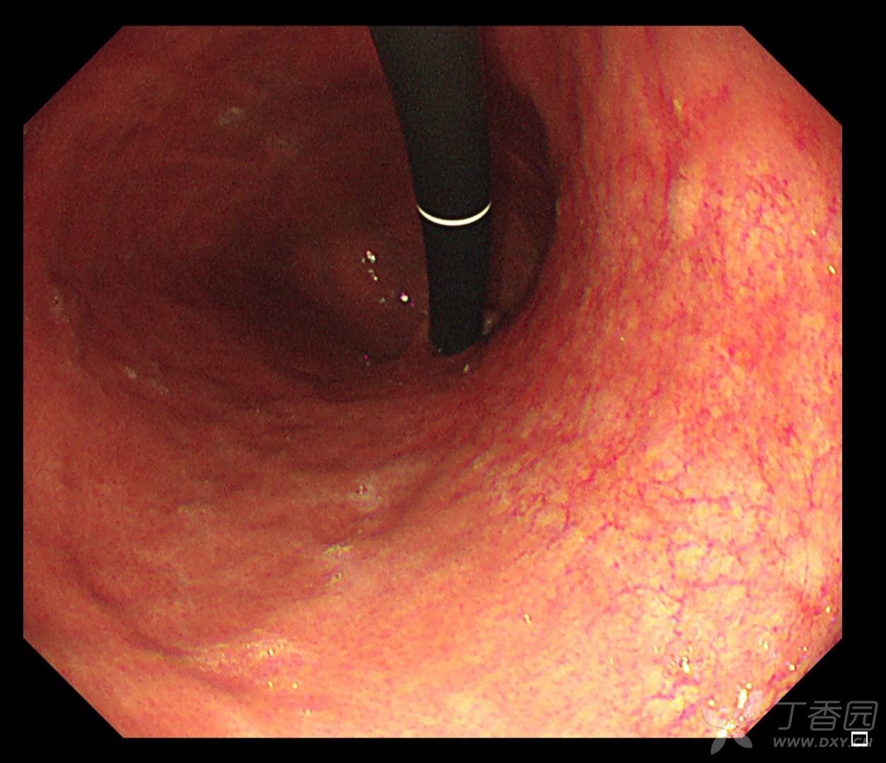 萎缩性胃炎胃镜图片图片