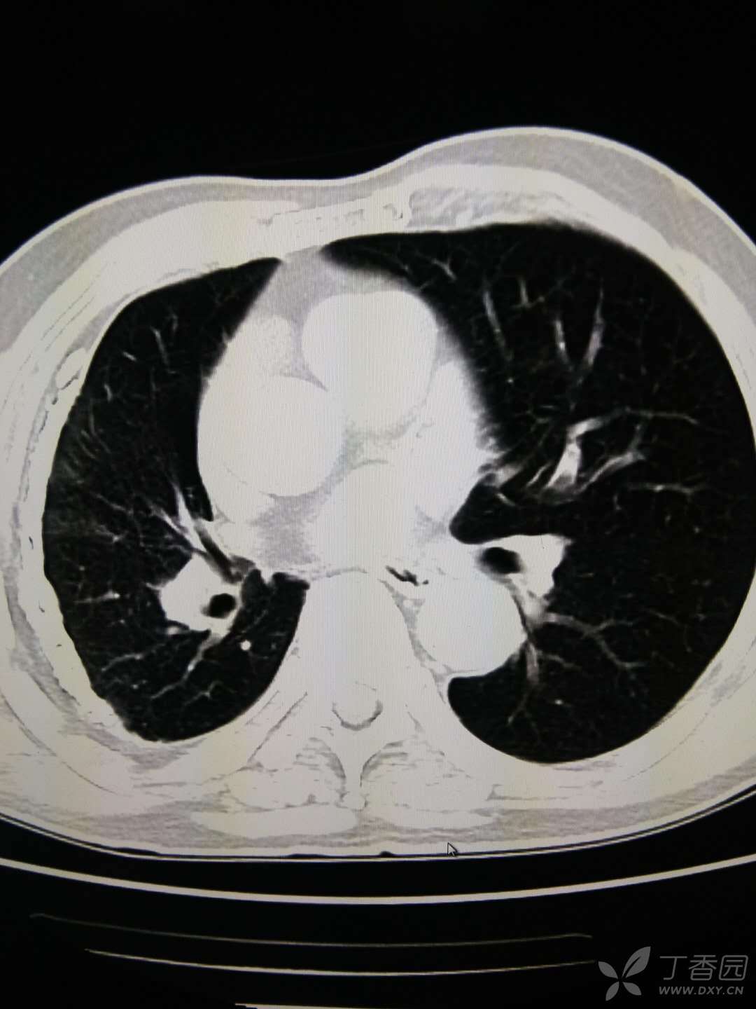 一個典型的胸片,當盔甲武裝到肺------最終章公佈ct結果在2樓 [病例帖