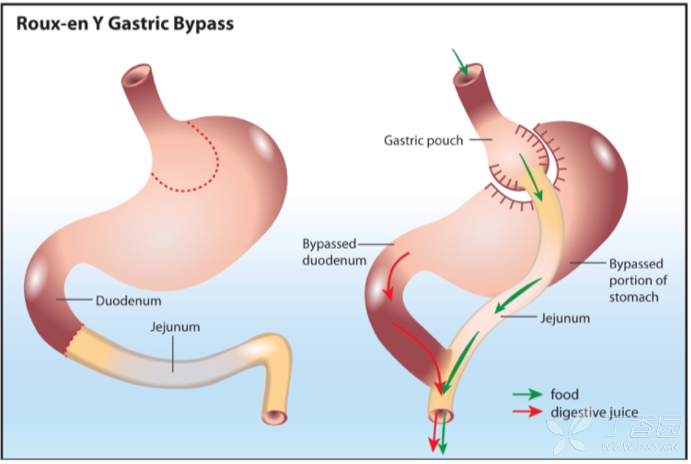 gastric sleeve和gastric bypass的区别