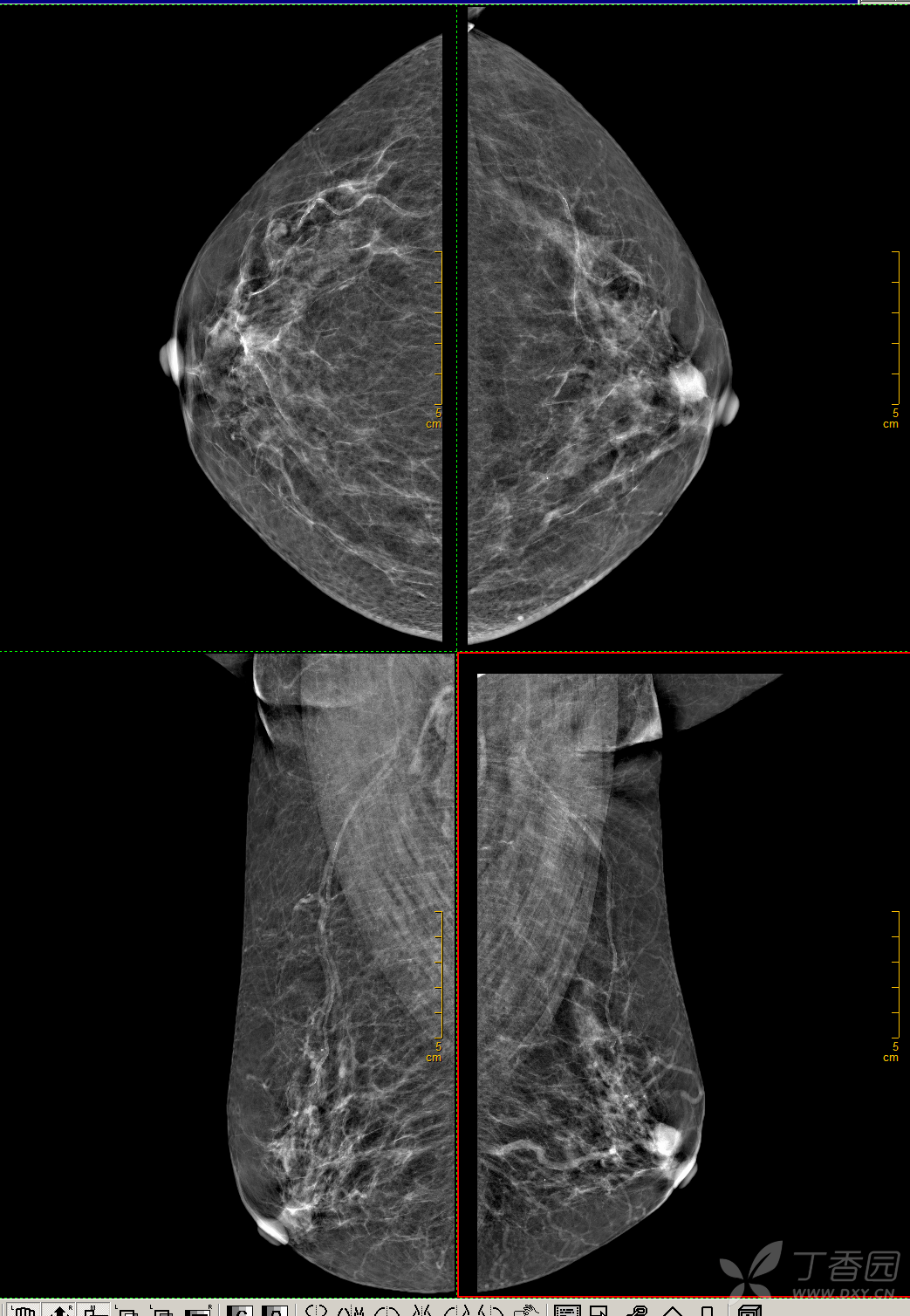 查体发现左乳肿物2天 [病例帖]