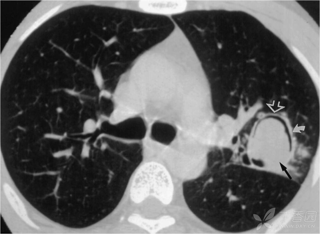 肺结核ct片图片图解,正常肺与肺结核t图片,肺结核图片和正常图片(第6页)_大山谷图库