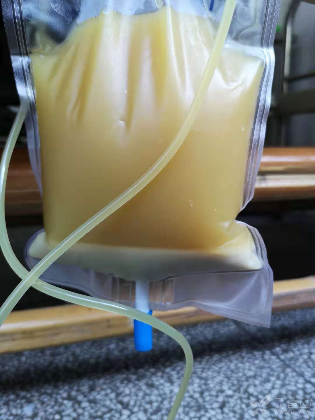 这样过目难忘的胸水你见过吗? [病例帖]