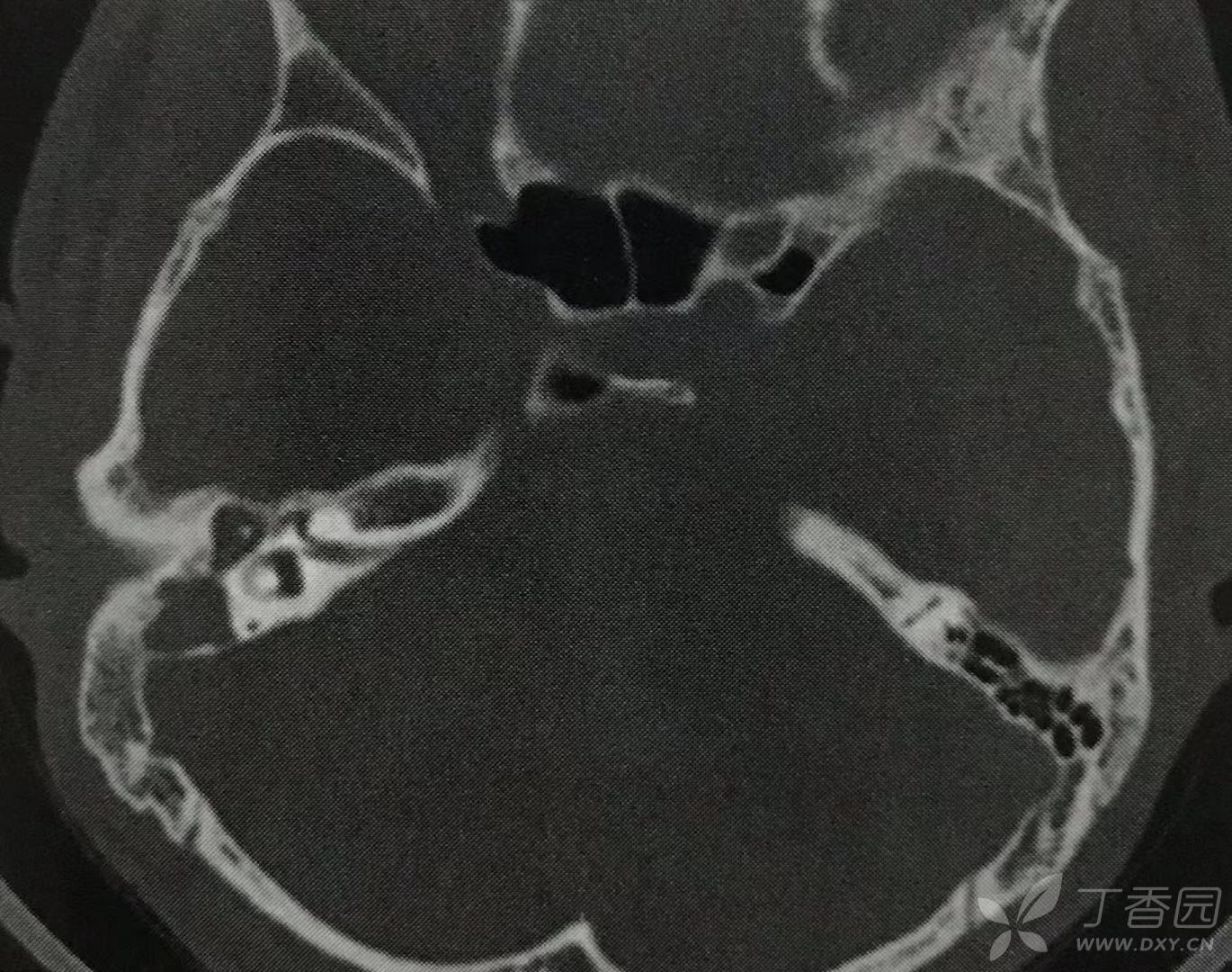 影像医学和核医学讨论版 普放 ct表现 1,单纯型患侧乳突气化不良,乳突