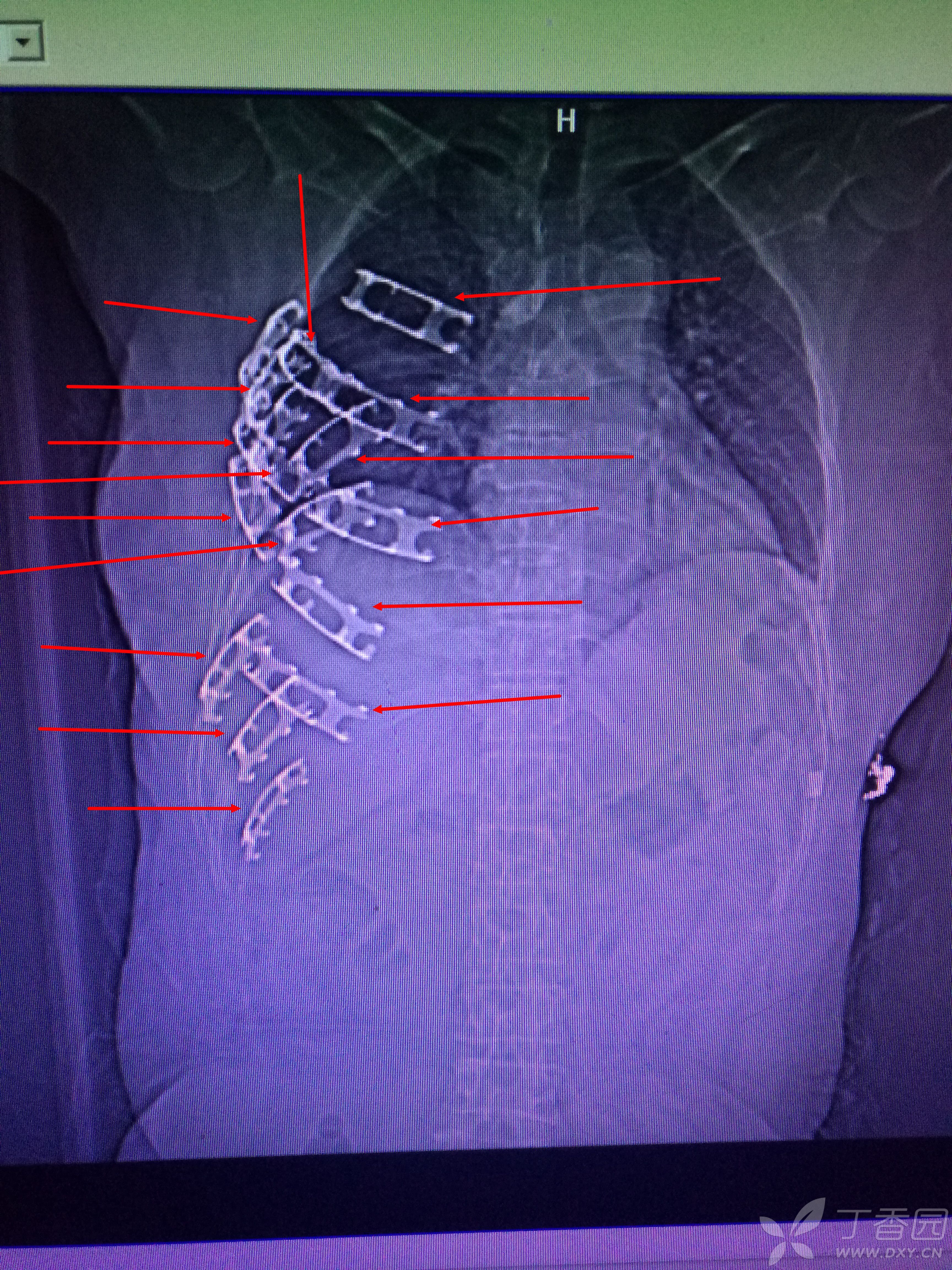 因患者原因,第一次行连枷胸术后ct重建影像,特分享