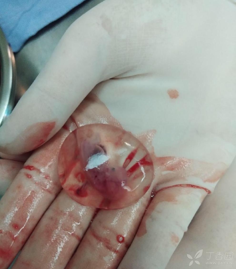 孕13周药流胎儿图片图片