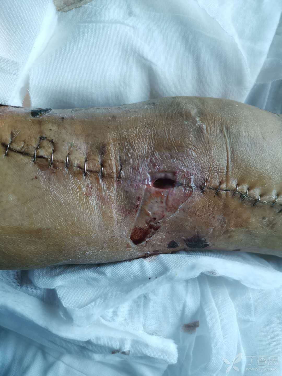 漂浮膝术后感染