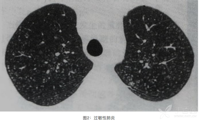 ct表现为双肺弥漫的小叶中心结节