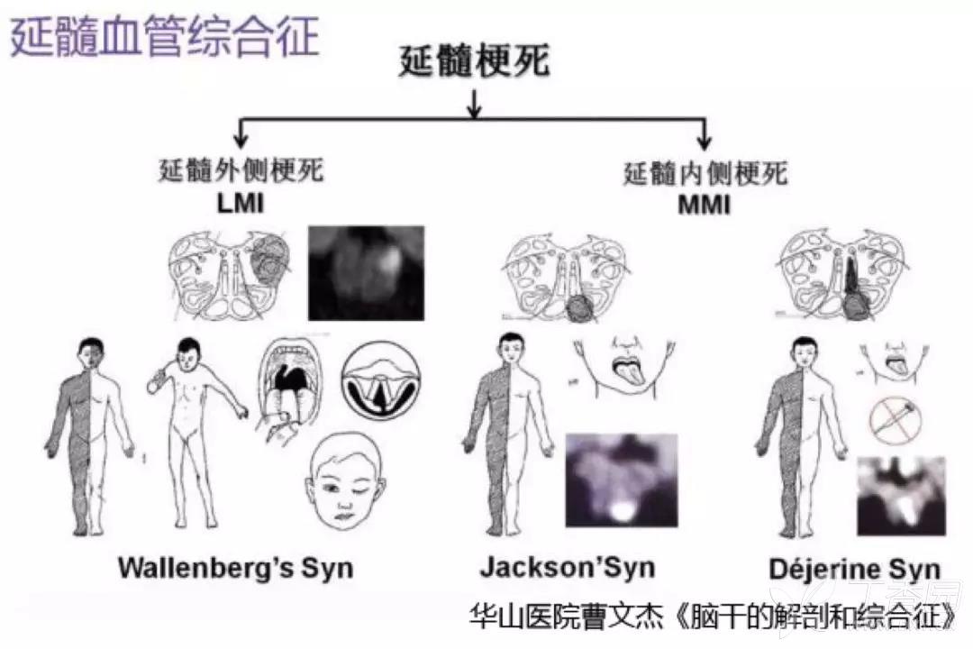 延髓病变主要有三个综合征,即 wallenberg, dejerine,jackson 综合征.