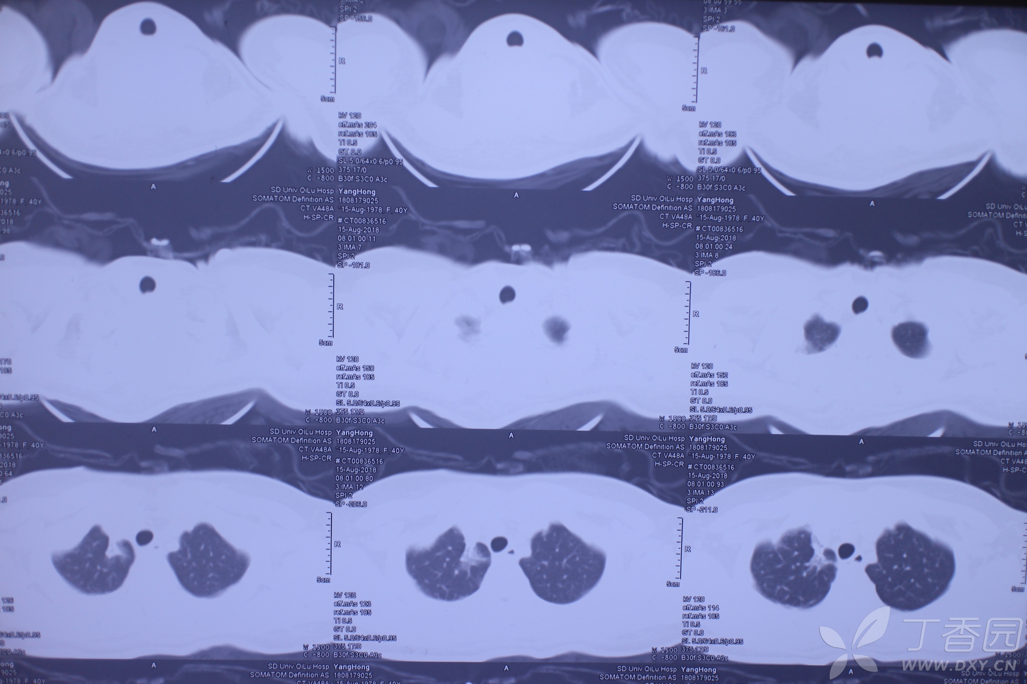 百草枯肺部损伤的特点:不会导致进行性肺纤维化 - 急救与危重病讨论版