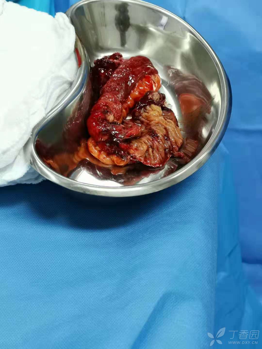 肠穿孔背后的可怕病因,elhers danlos综合征4型,求治疗方案.