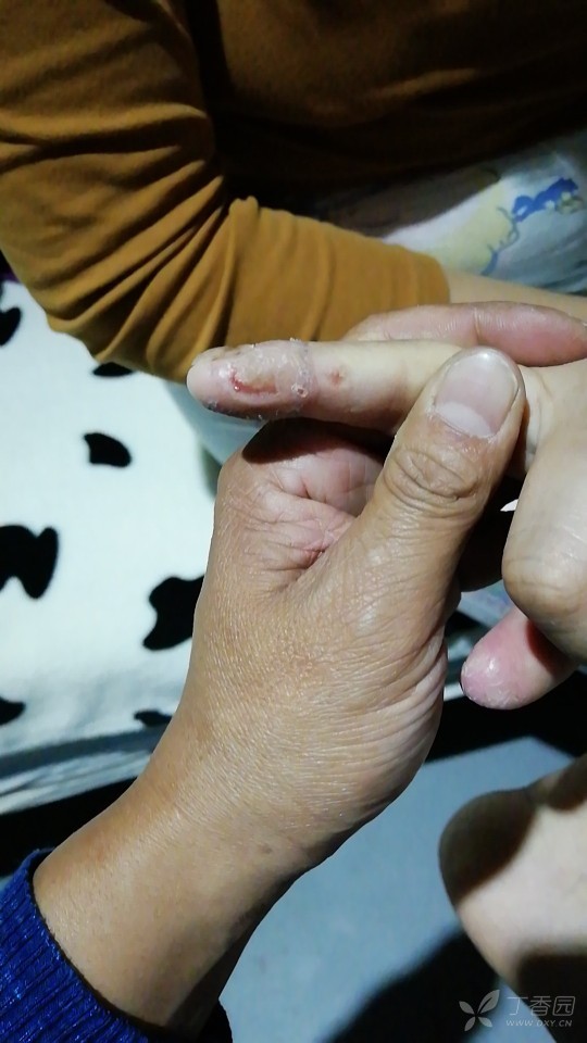 手指坏死早期症状图片图片