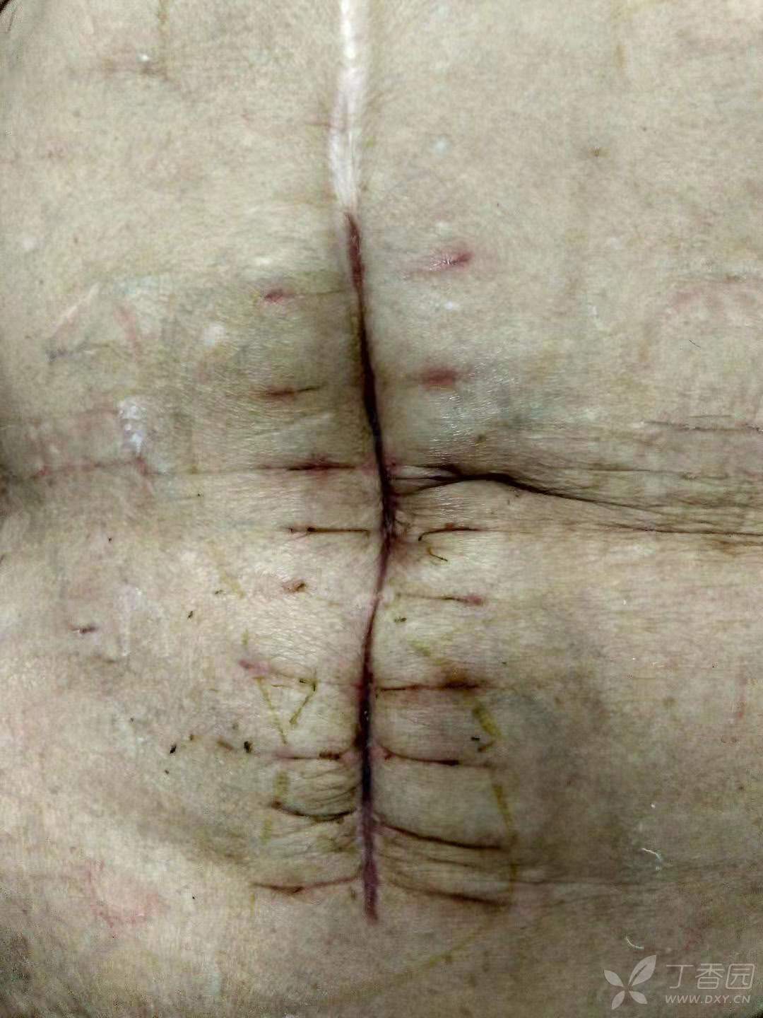 男人肚子受伤缝针图片图片