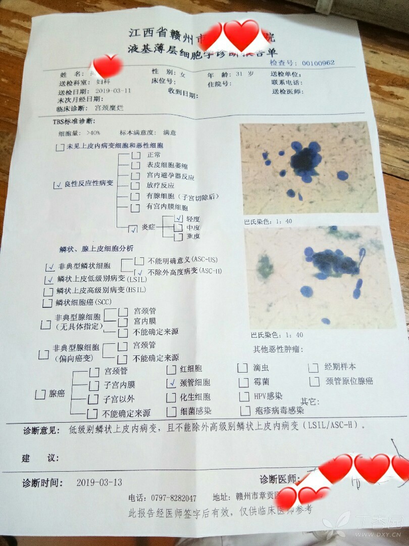 低级别鳞状上皮病变