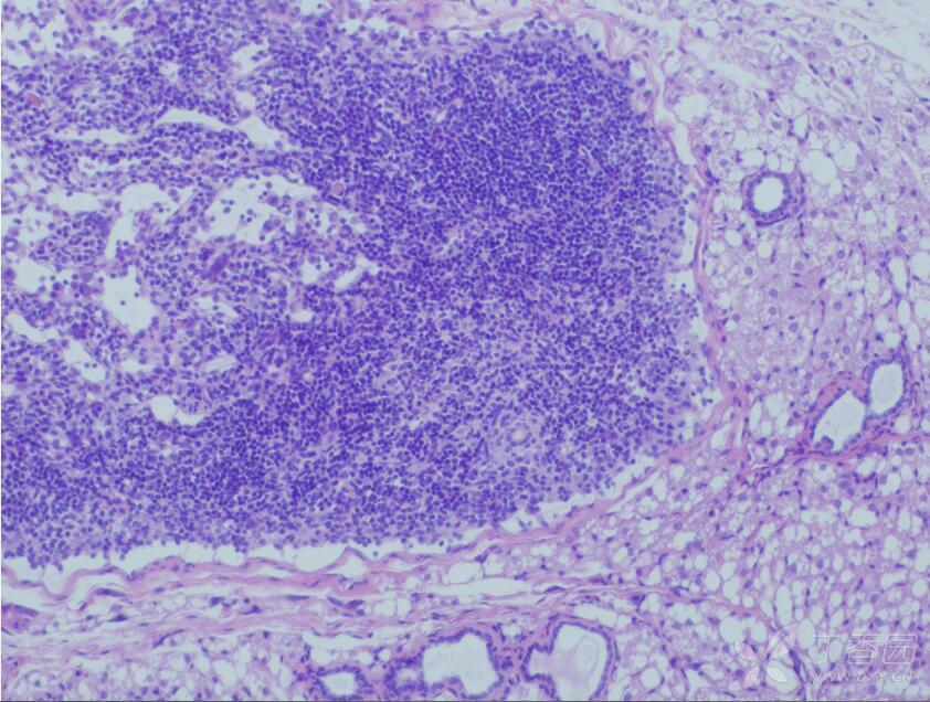 he染色读片,能否帮忙看一下下面几张片子里面有没有肿瘤转移