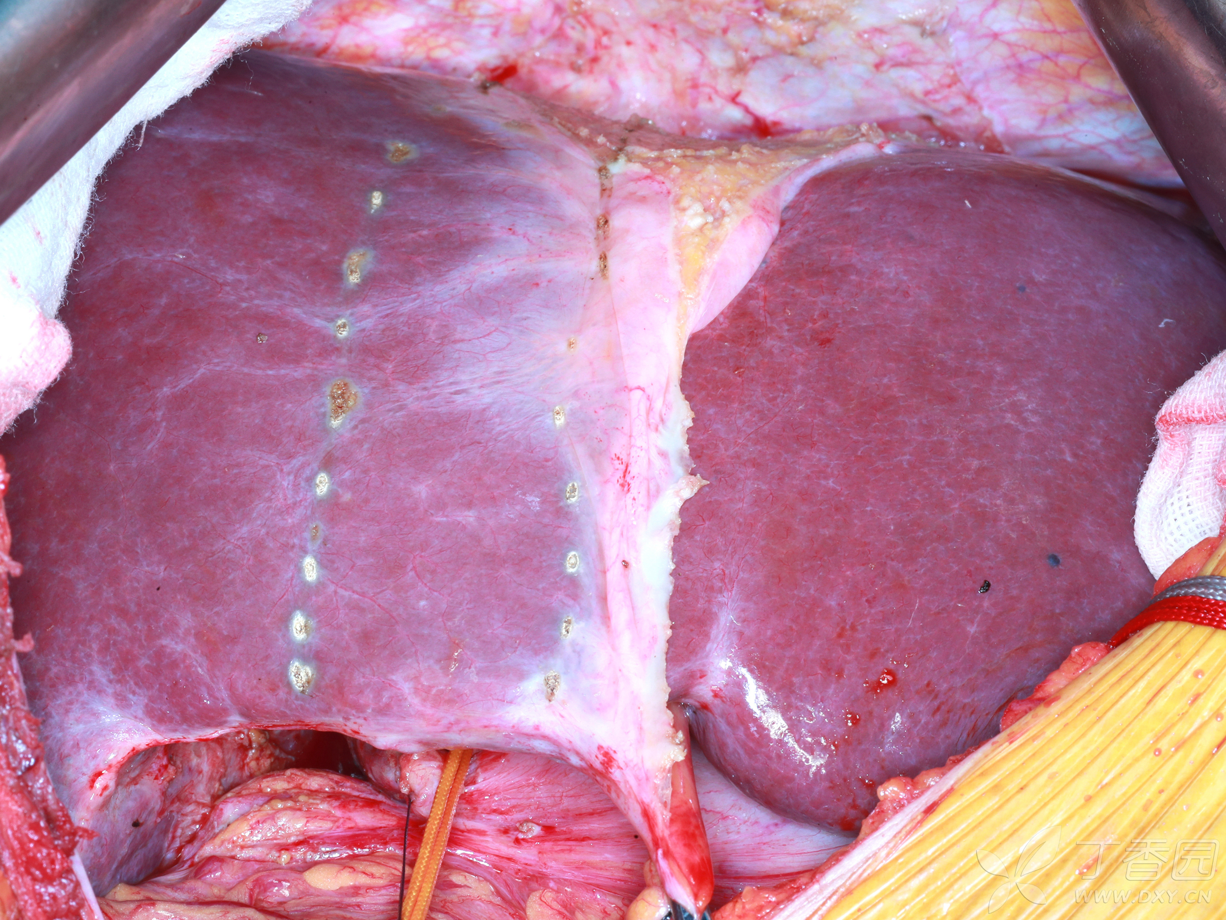 iv段联合尾状叶切除治疗ii型肝门部胆管癌