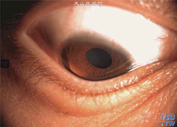 圆锥角膜的方方面面以及角膜地形图(自我学习与分享)