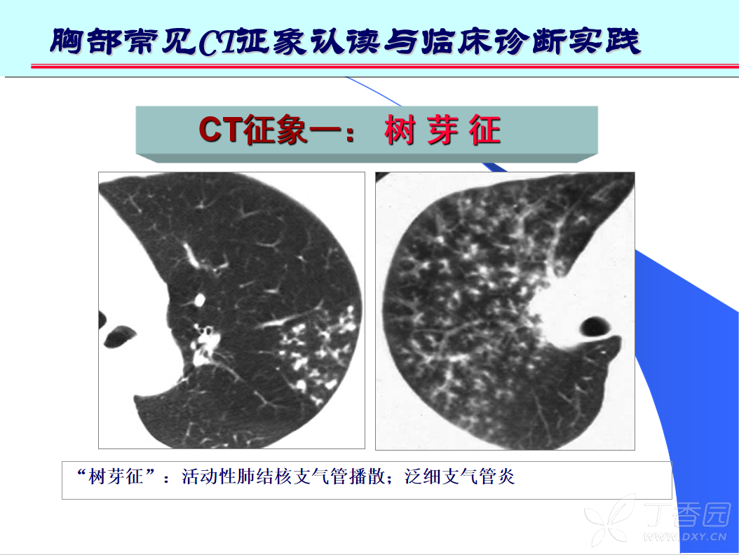 活动性肺结核图片