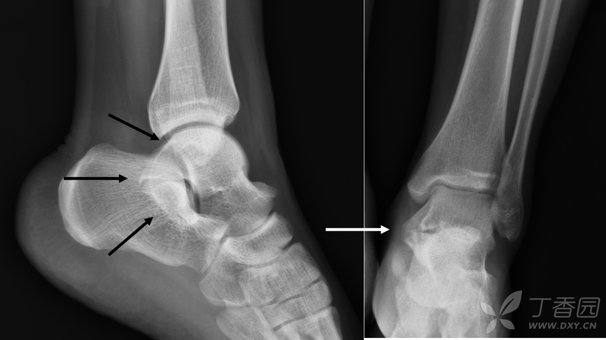 讲座 c字征是指在踝关节侧位片上,距骨内侧轮廓与跟骨的载距突轮廓