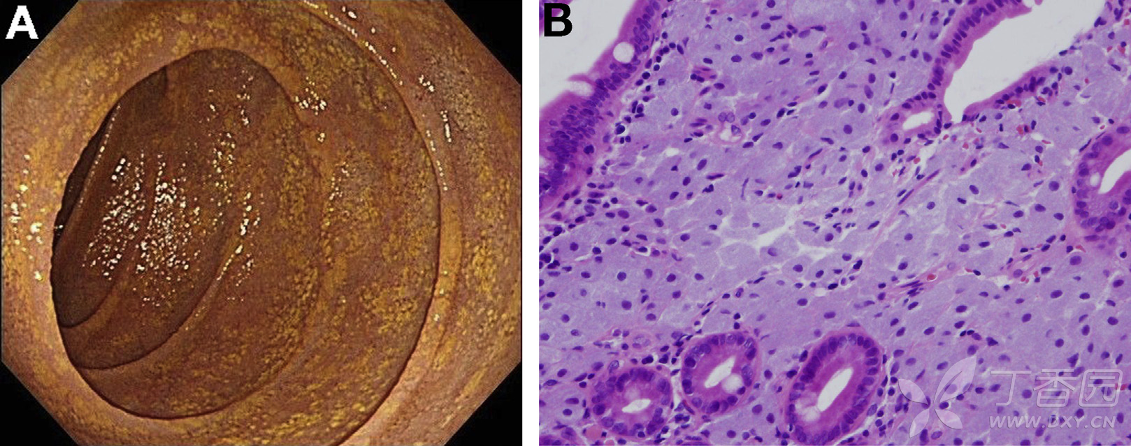 6年前曾患阿米巴肝脓肿并于当时确诊hiv感染,此后未再就医.